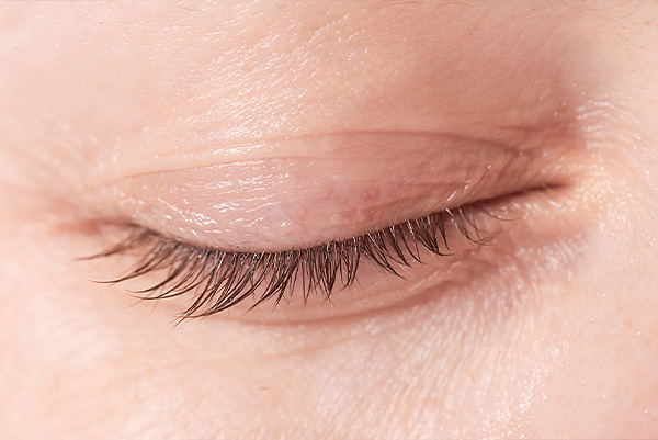Clean eyelid – Blepharitis – BlephEx – Contact lens intolerance