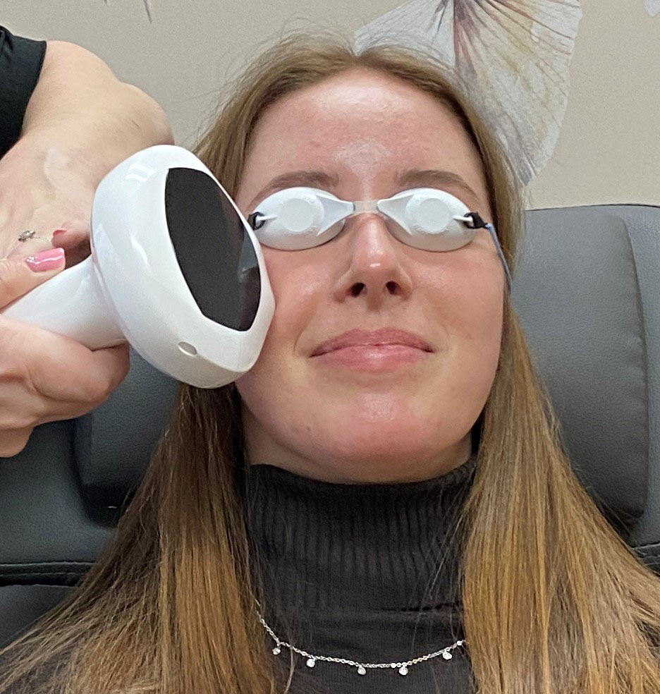 Woman with ocular rosacea receiving Lumecca IPL – dry eye treatment for Meibomian – gland disease - Boardwalk -Optometry