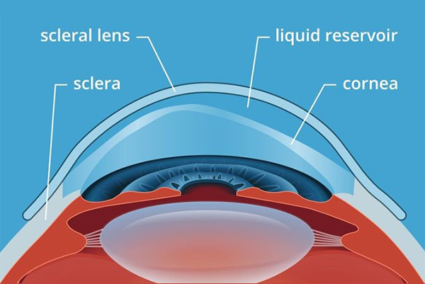 How a scleral lens sits on the eye - Specialty contact lens for severe dry eye - Licensed opticians - Boardwalk Optometry